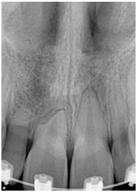 Impacted Canine Xray - Jason Erasmus