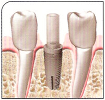 Teeth implants figure - Jason Erasmus