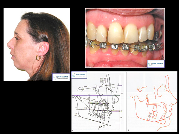 FIBRO‐SARCOMA OF THE LOWER JAW - HAMILTON - 1945 - Australian and New  Zealand Journal of Surgery - Wiley Online Library